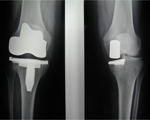 Radiografia di protesi totale a sinistra e monocompartimentale a destra